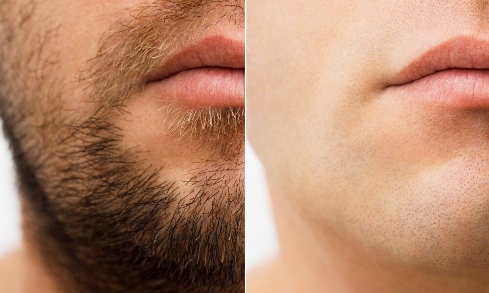 how-to-find-the-best-laser-hair-removal-for-men-in-chicago